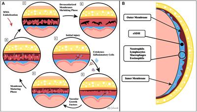 Advances in chronic subdural hematoma and membrane imaging